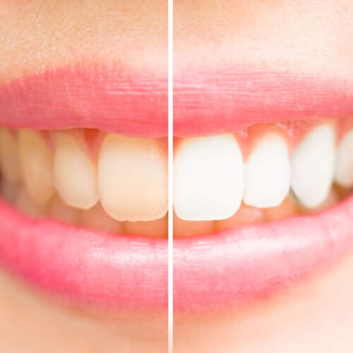 Blanqueamiento dental