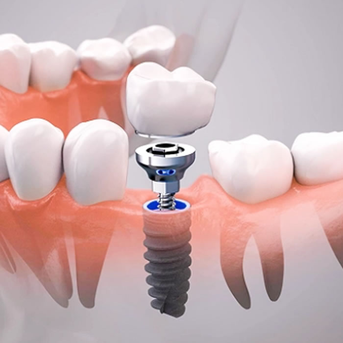 Implante dental en Odontobel